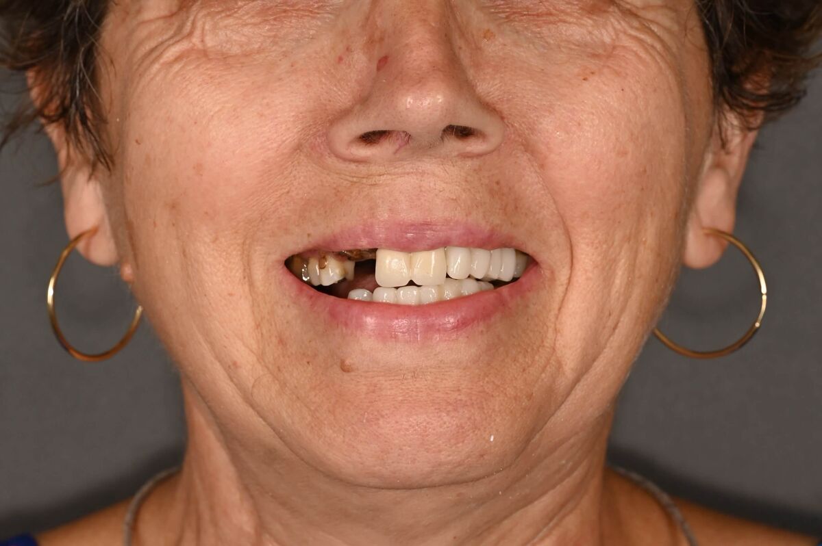 boteanu ilinca - inainte